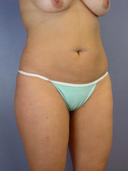 Liposuction Before & After Image