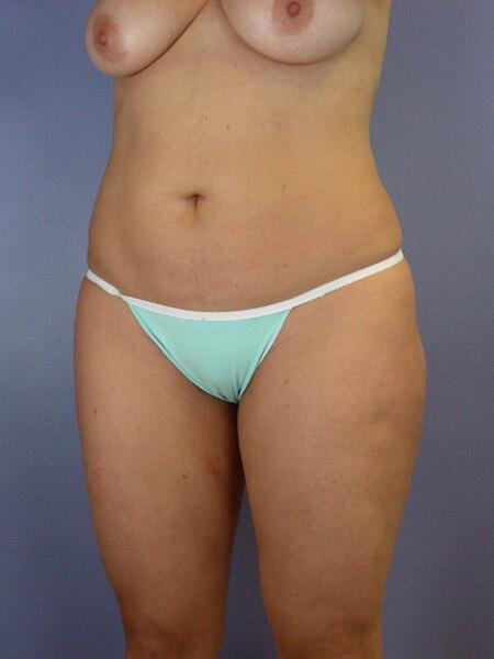 Liposuction Before & After Image