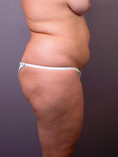 Liposuction Before & After Image