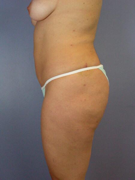 Liposuction Before & After Image