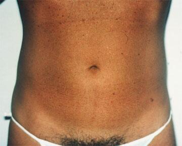 Liposuction Before & After Image