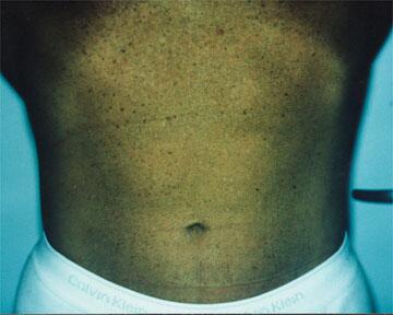 Liposuction Before & After Image