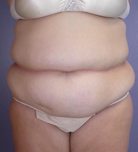 Liposuction Before & After Image