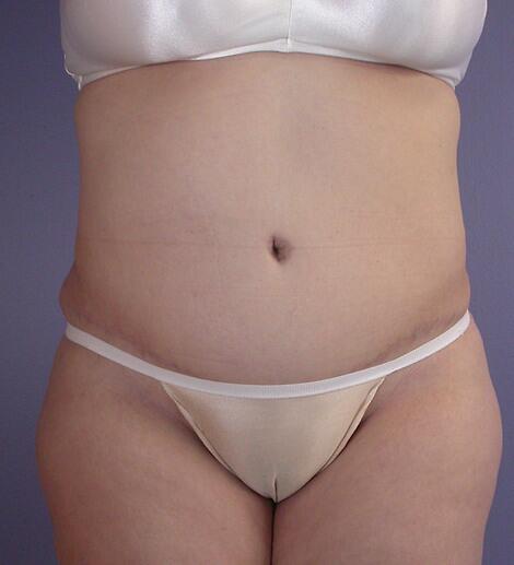 Liposuction Before & After Image