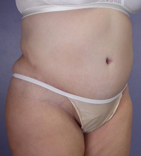 Liposuction Before & After Image