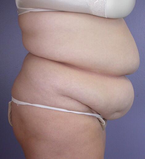 Liposuction Before & After Image