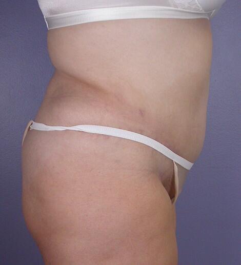 Liposuction Before & After Image