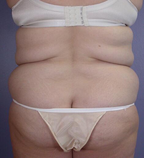 Liposuction Before & After Image