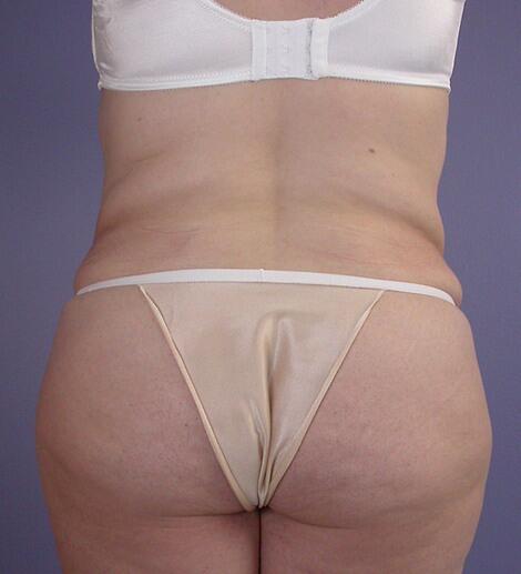 Liposuction Before & After Image