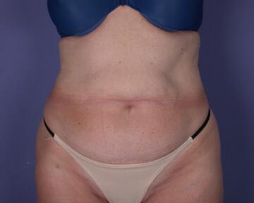 Liposuction Before & After Image