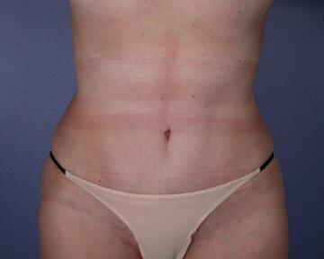 Liposuction Before & After Image