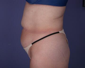 Liposuction Before & After Image