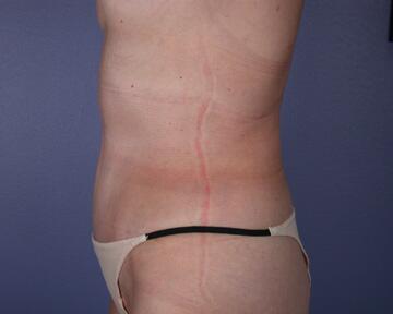 Liposuction Before & After Image