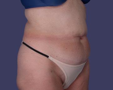 Liposuction Before & After Image