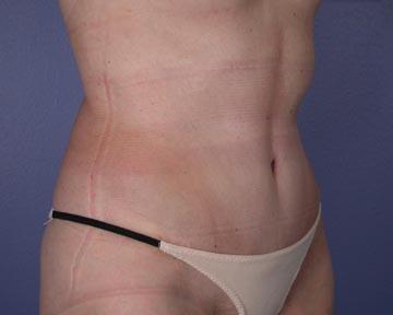 Liposuction Before & After Image