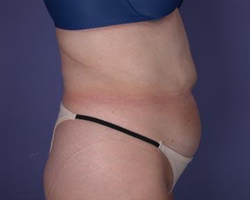 Liposuction Before & After Image