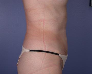 Liposuction Before & After Image