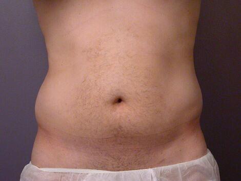 Liposuction Before & After Image