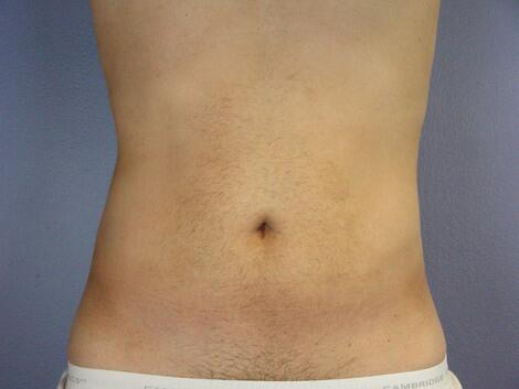 Liposuction Before & After Image