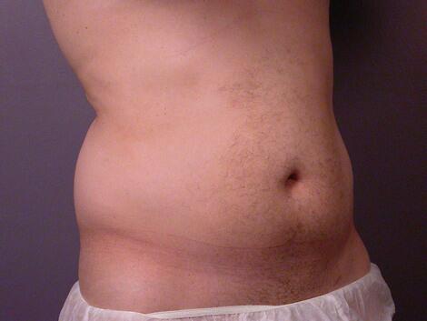 Liposuction Before & After Image