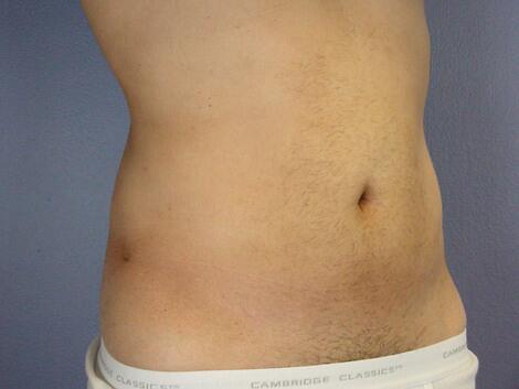 Liposuction Before & After Image