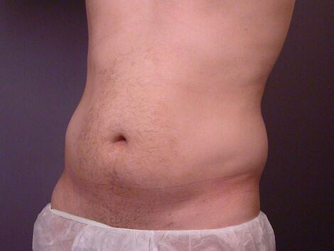 Liposuction Before & After Image