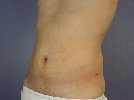 Liposuction Before & After Image