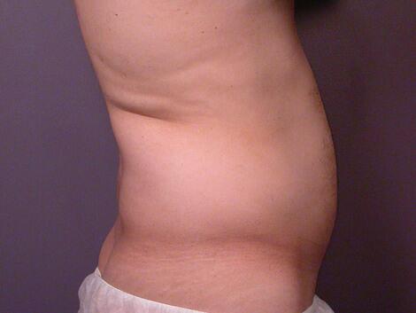 Liposuction Before & After Image