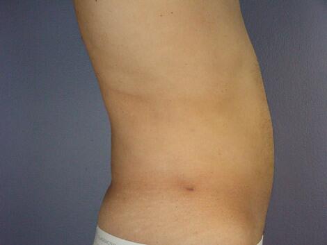 Liposuction Before & After Image