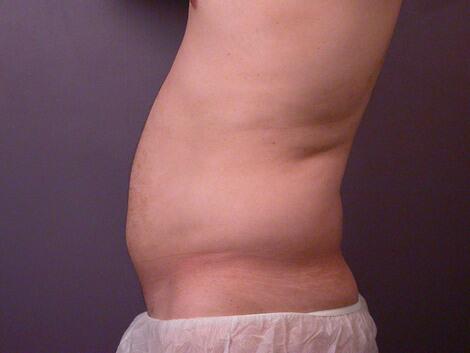 Liposuction Before & After Image