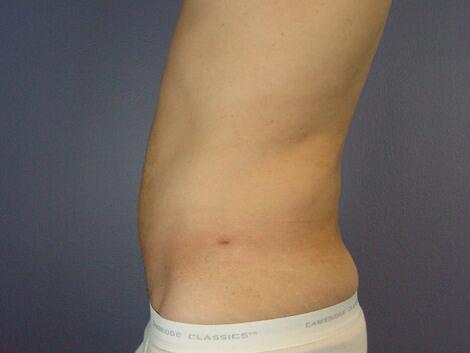 Liposuction Before & After Image