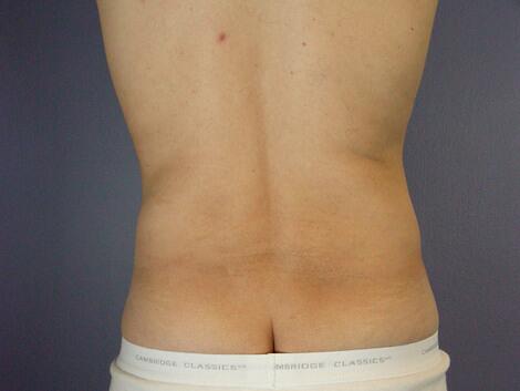 Liposuction Before & After Image