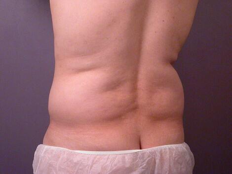 Liposuction Before & After Image