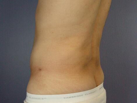 Liposuction Before & After Image