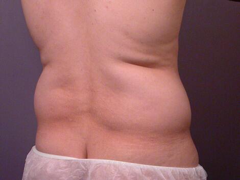 Liposuction Before & After Image