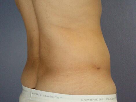 Liposuction Before & After Image