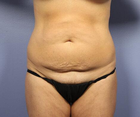 Liposuction Before & After Image