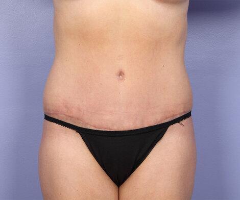 Liposuction Before & After Image