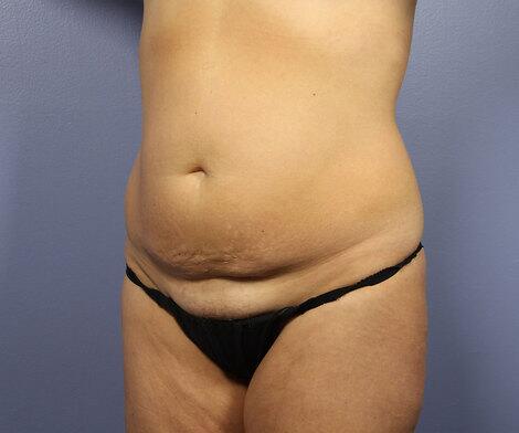 Liposuction Before & After Image