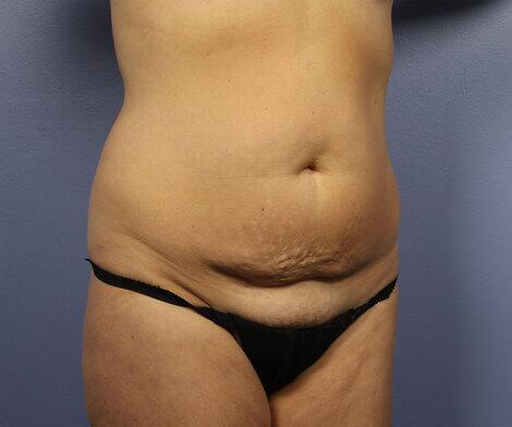 Liposuction Before & After Image