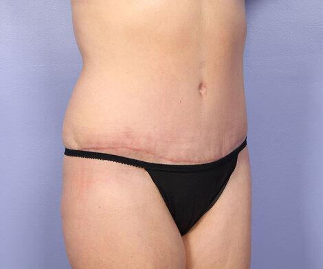 Liposuction Before & After Image