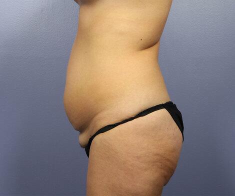 Liposuction Before & After Image