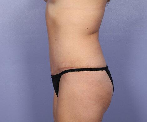 Liposuction Before & After Image