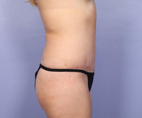 Liposuction Before & After Image