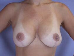 Liposuction Before & After Image