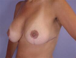 Liposuction Before & After Image