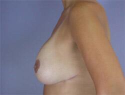 Liposuction Before & After Image