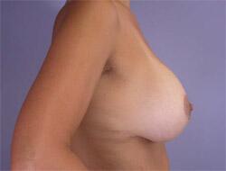 Liposuction Before & After Image