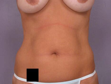 Liposuction Before & After Image