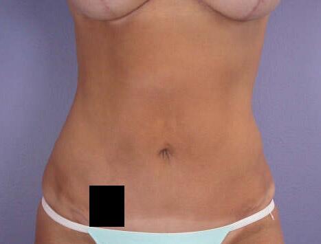 Liposuction Before & After Image